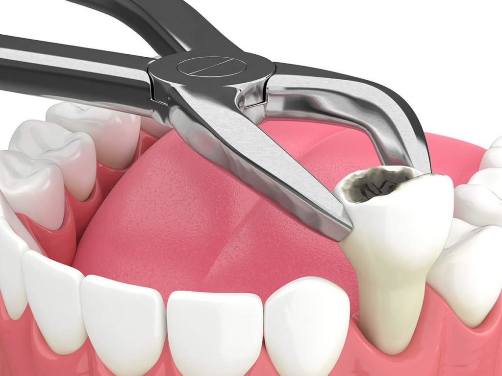 illustration of tooth being extracted using dental tools