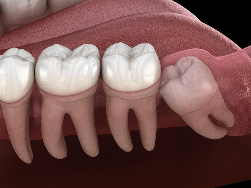 illustration of an impacted wisdom tooth that needs removed