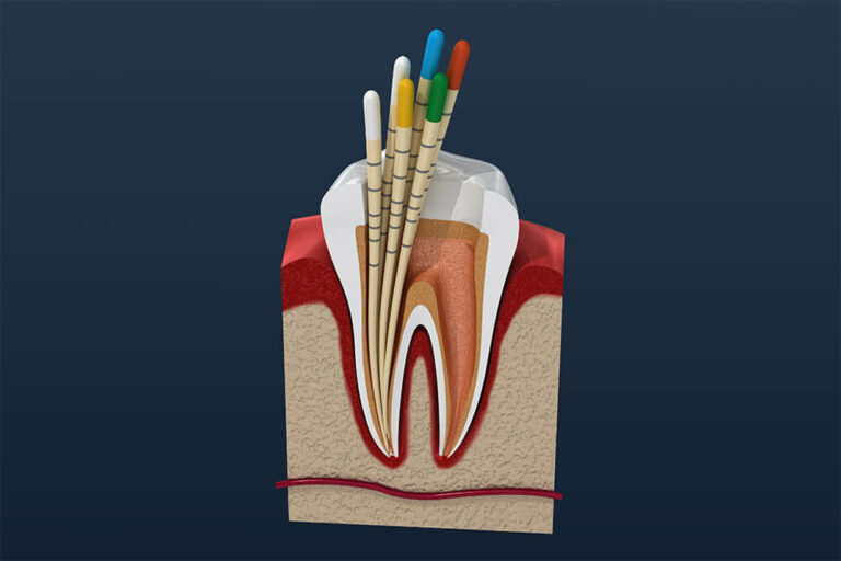 root canal illustration