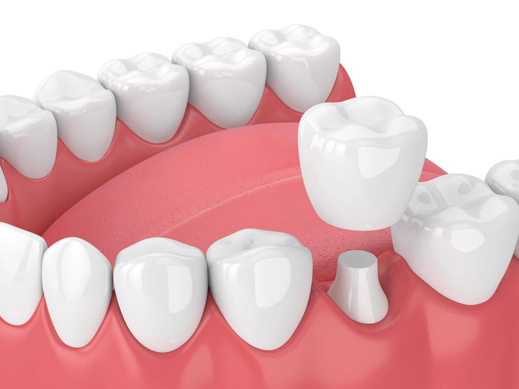 illustration of dental crown being placed on tooth