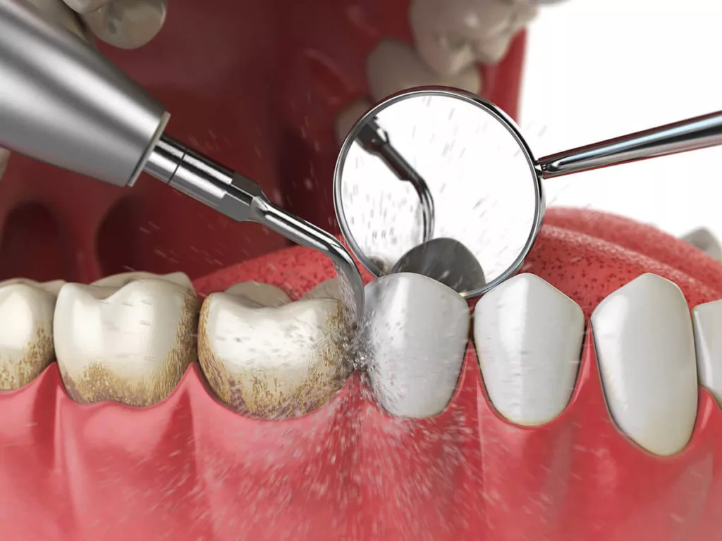 It shows a dental scaler being used to remove plaque and tartar from a tooth, with a dental mirror reflecting the process. Water or another liquid is used to aid in the cleaning, highlighting a common dental hygiene practice.
