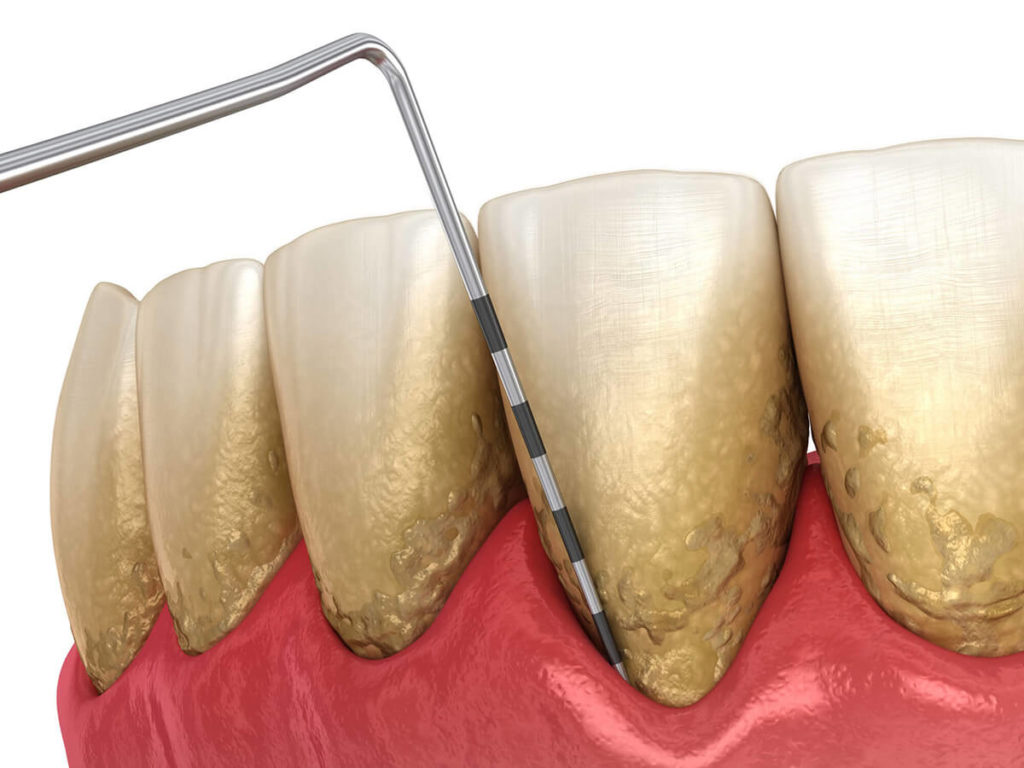 illustration of teeth with periodontal disease