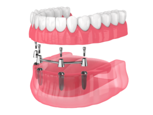 illustration of all on 4 dental implants